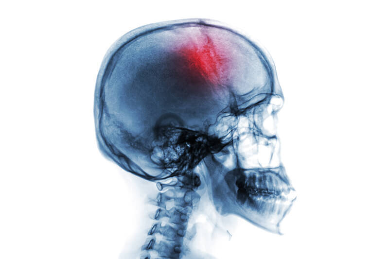 Image from a head CT scan